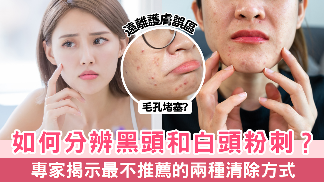 如何分辨黑頭和白頭粉刺?專家揭示最不推薦的兩種清除方式