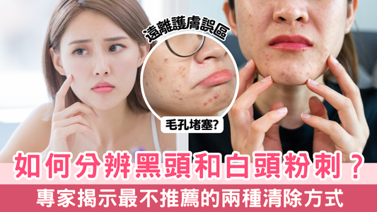 如何分辨黑頭和白頭粉刺?專家揭示最不推薦的兩種清除方式