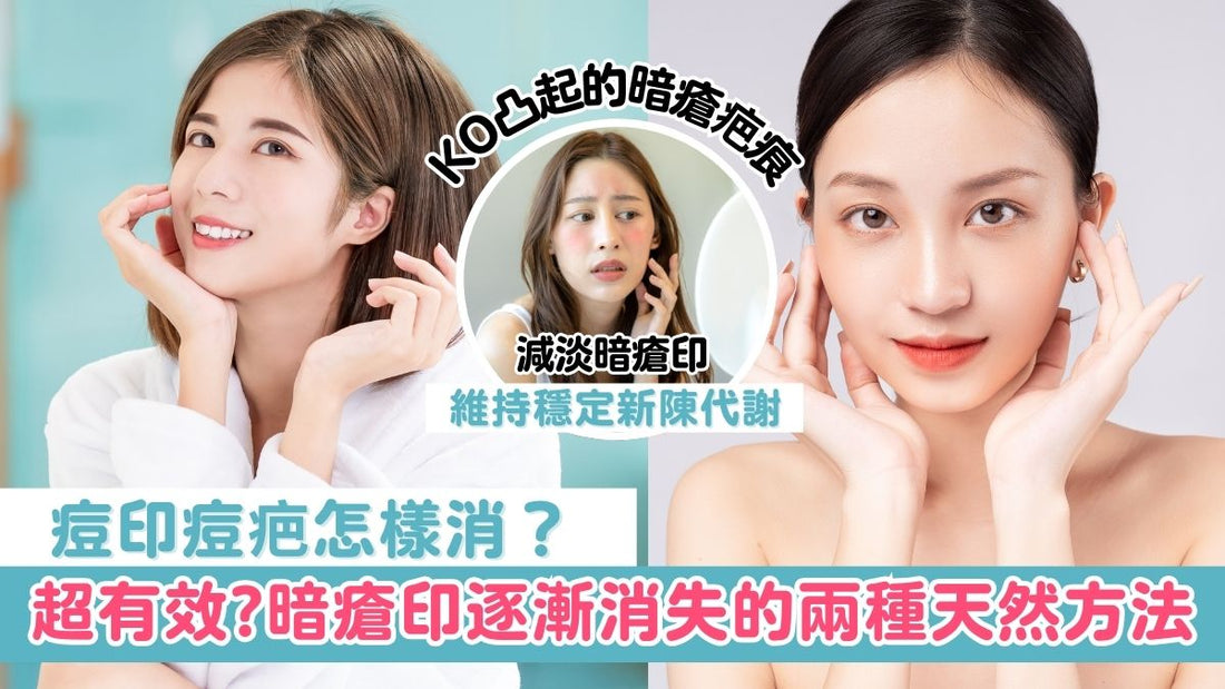 【皮膚管理】暗瘡印逐漸消失的兩種天然方法
