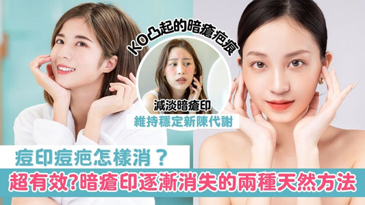 【皮膚管理】暗瘡印逐漸消失的兩種天然方法
