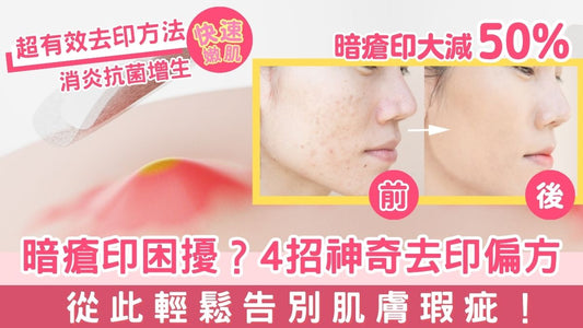 暗瘡困擾?4招神奇去印偏方,輕鬆告別肌膚瑕疵!