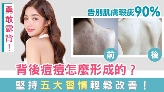 【內分泌調理】背後痘痘怎麼形成?教你五大習慣輕鬆改善!