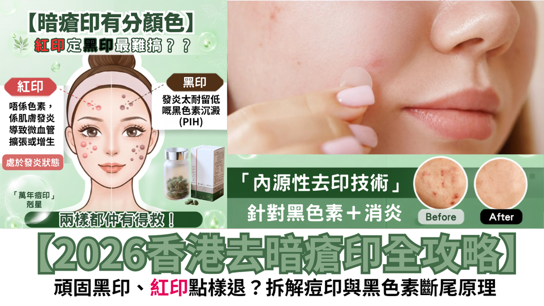 【2026香港去暗瘡印全攻略】頑固黑印、紅印點樣退？拆解痘印與黑色素斷尾原理，加映 Inness 痘印種子真實評測