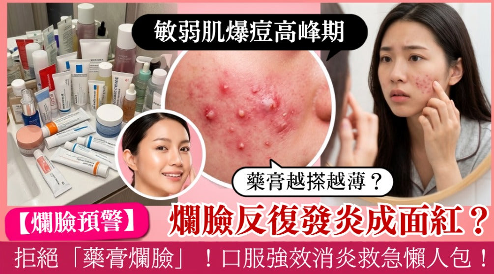 【敏弱肌必睇】爛臉反復發炎成面紅腫？擦藥膏擦到皮膚變薄！「口服強效消炎法」徹底斷尾