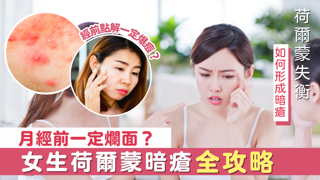 月經前一定爛面？女生荷爾蒙暗瘡全攻略